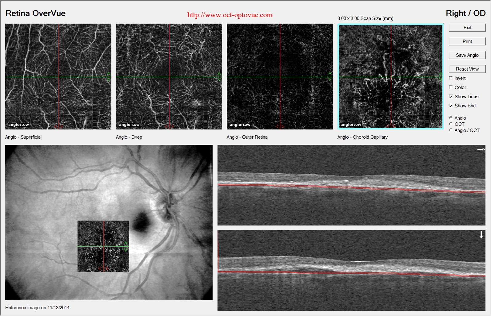 armd angiovue lucentis eyelea anti-vegf muratet