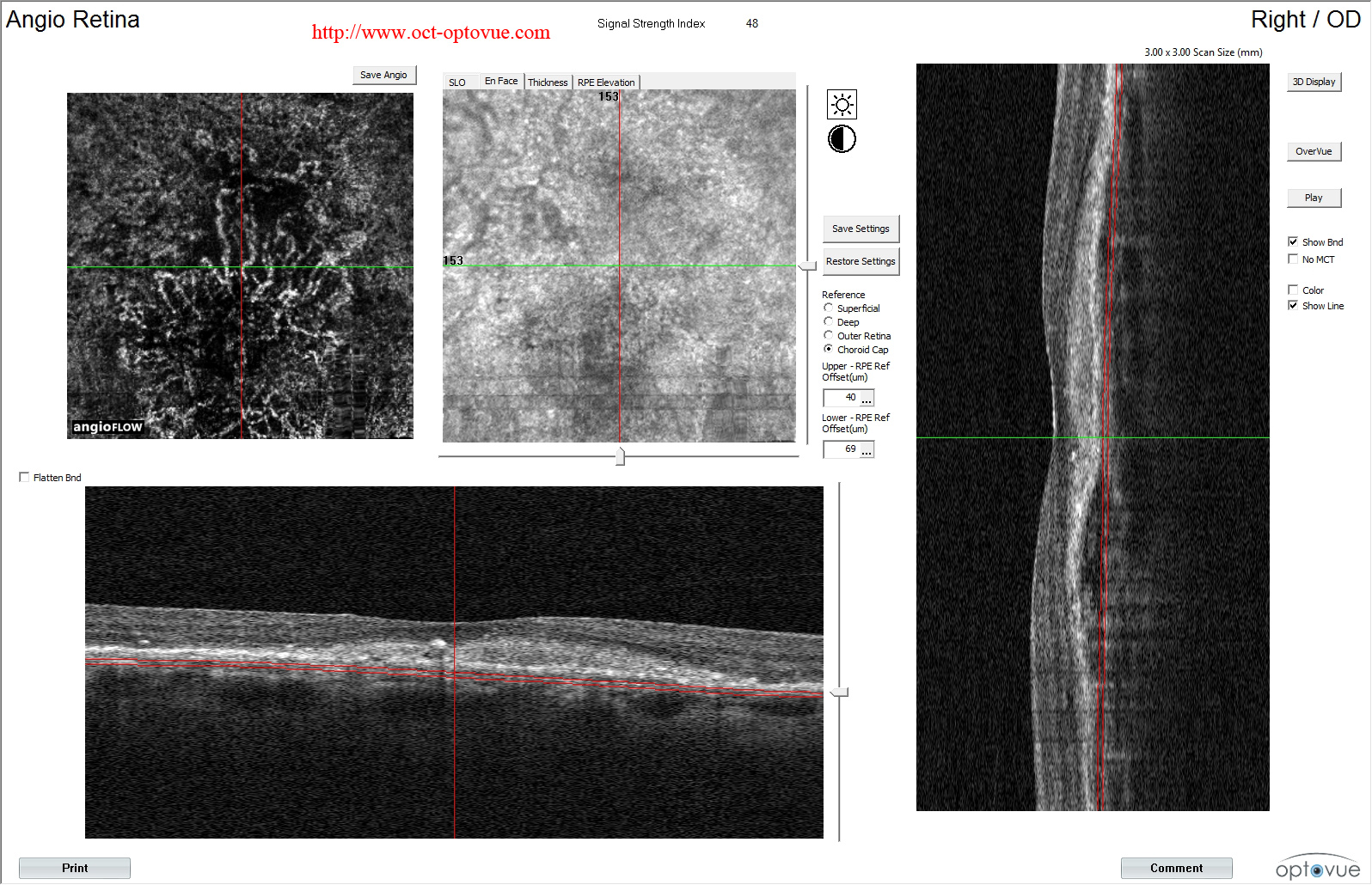 armd angiovue cnv neovaisseau dmal amd