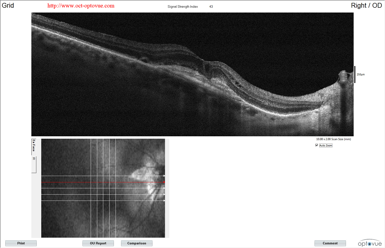 amd anigiovue lucentis eyelea muratet pamiers france