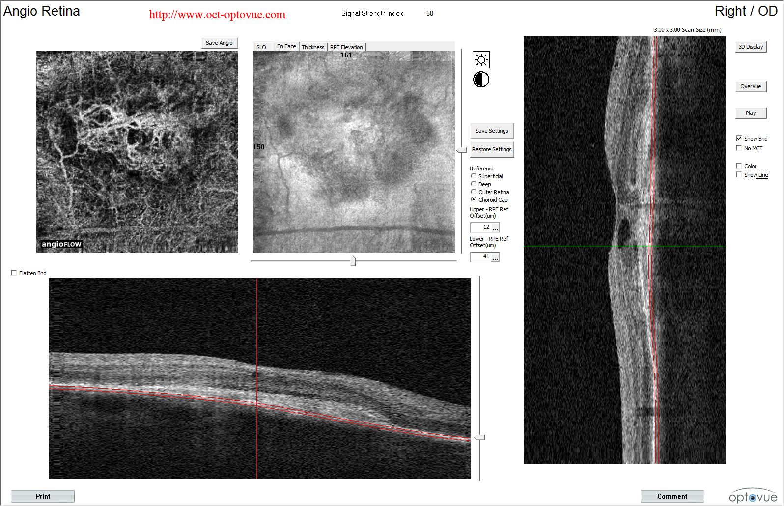 amd anigiovue lucentis novartis eyelea muratet pamiers france