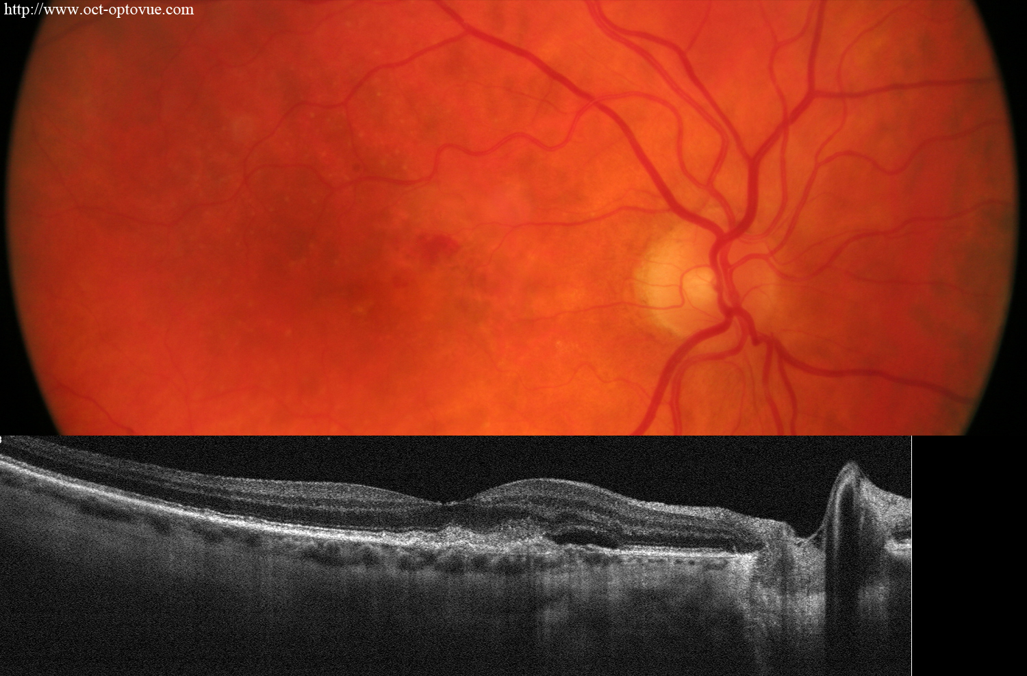 recurrent cnv angio oct