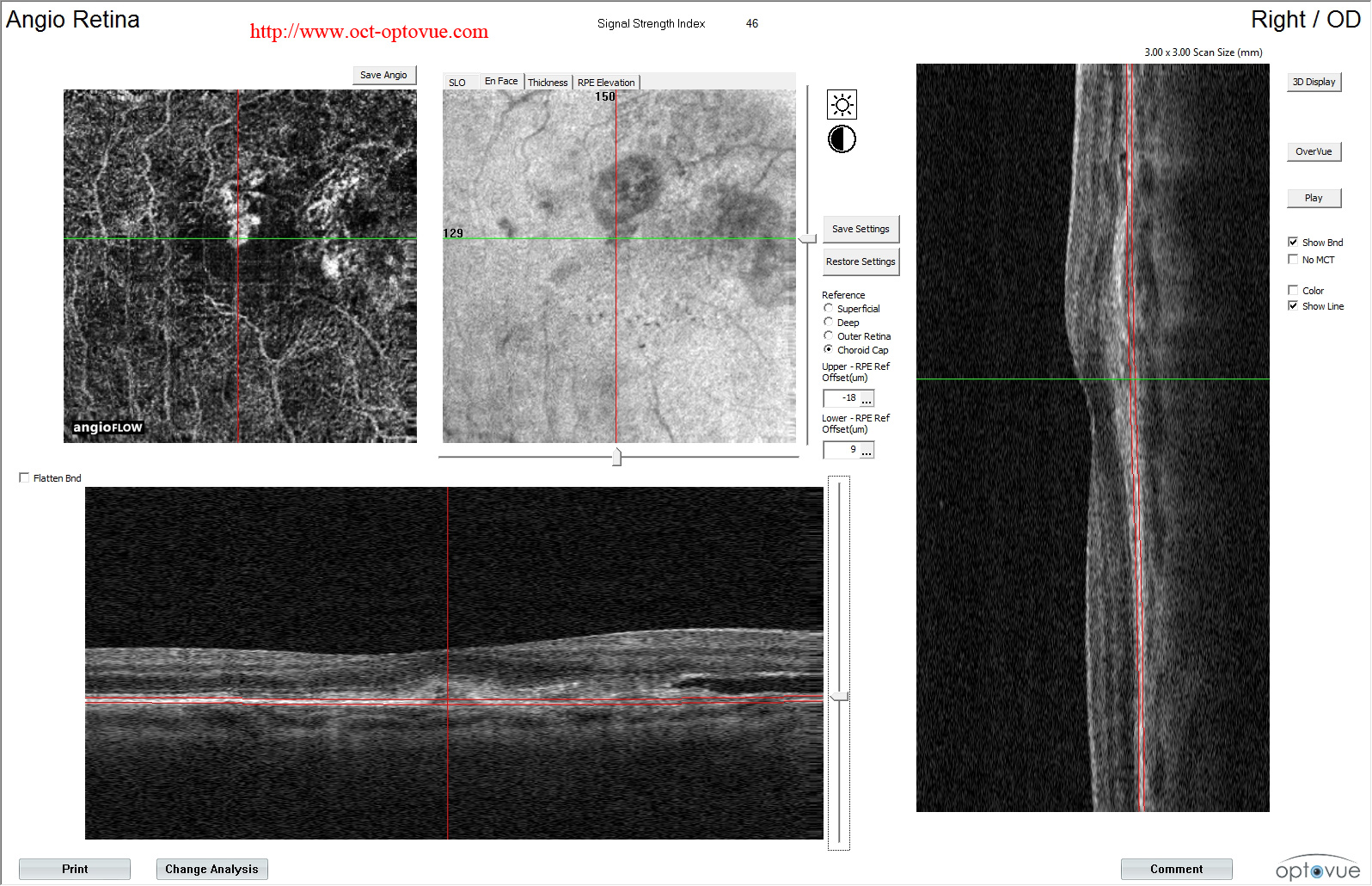 recurrent cnv angio oct lucentis novartis eylea