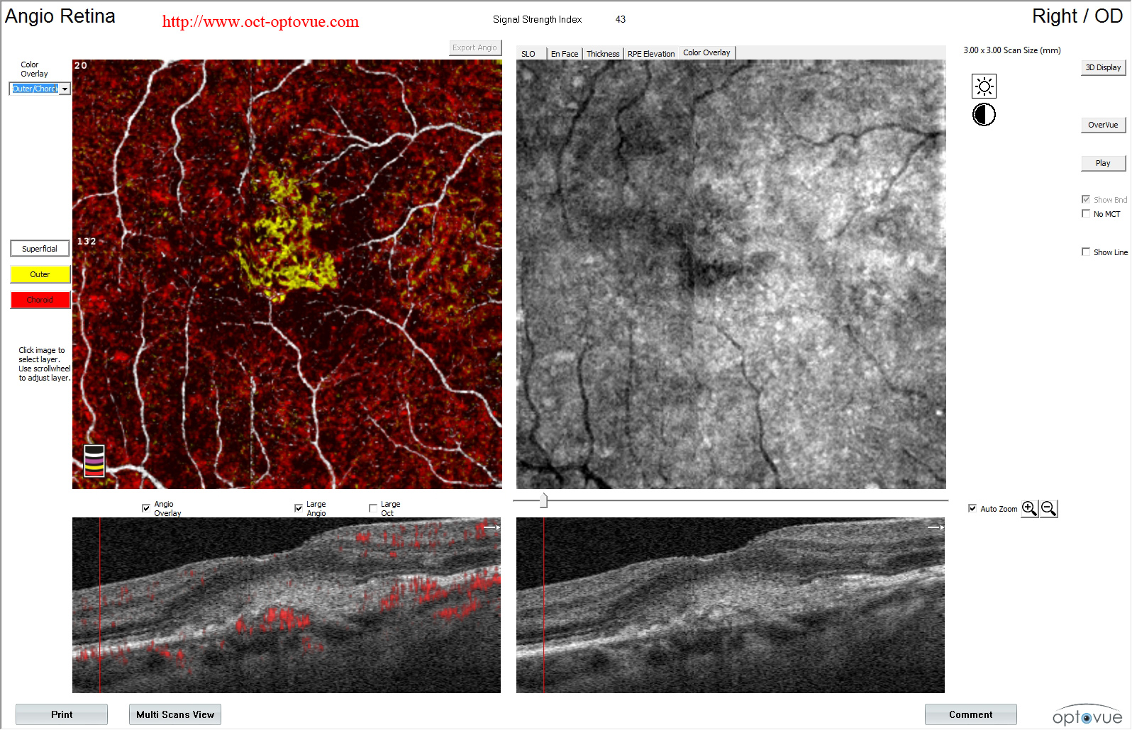 recurrence cnv oct angiography