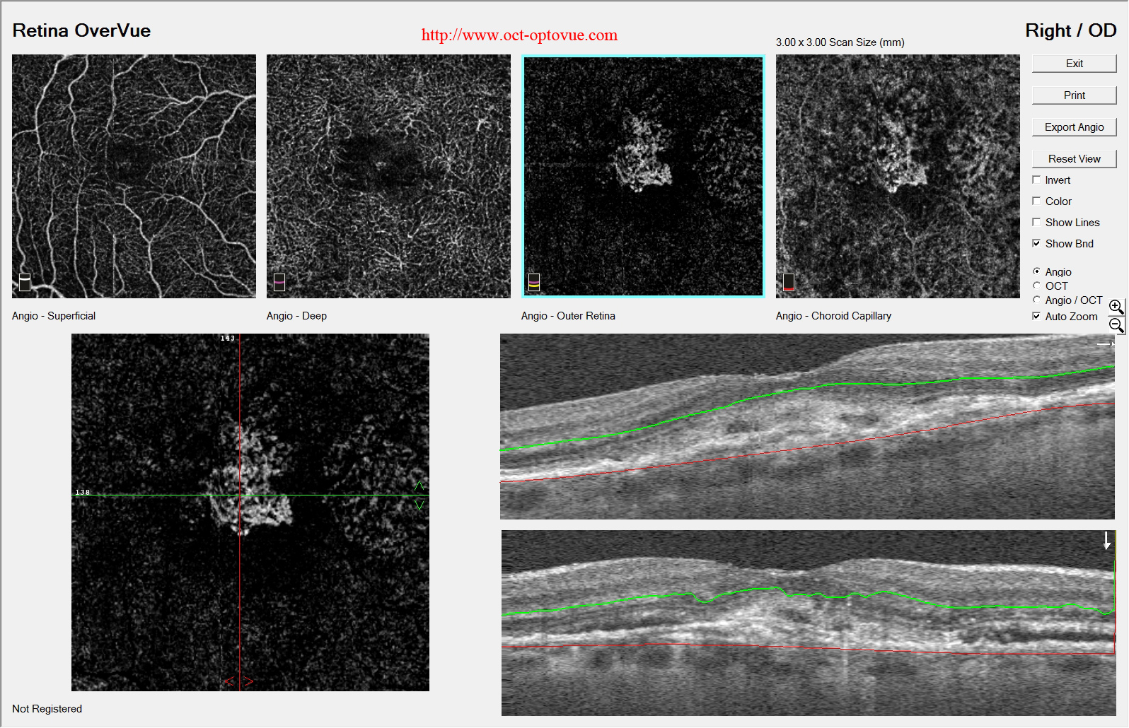 recurrent cnv oct angiography