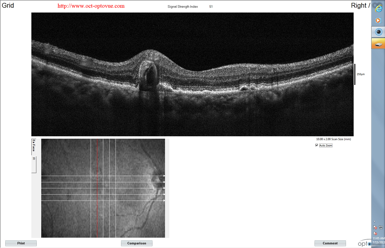 panoramic-cnv-octa recurrent cnv