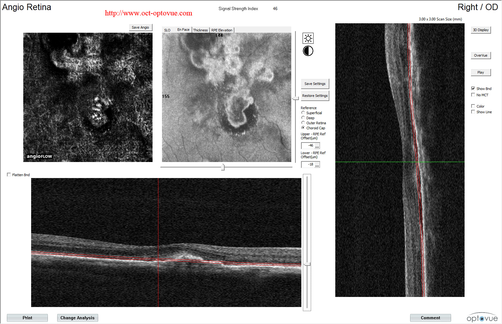 panoramic-cnv-octa recurrent cnv dmla exsudative