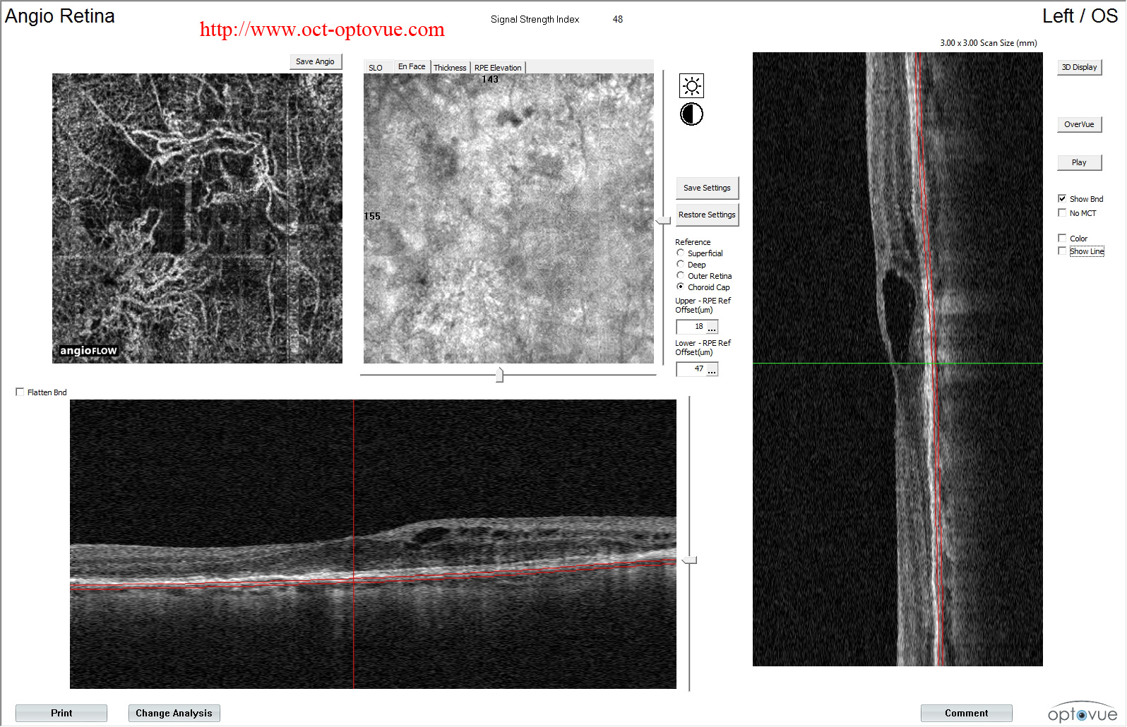 recurrent armd cnv recidvie angio oct