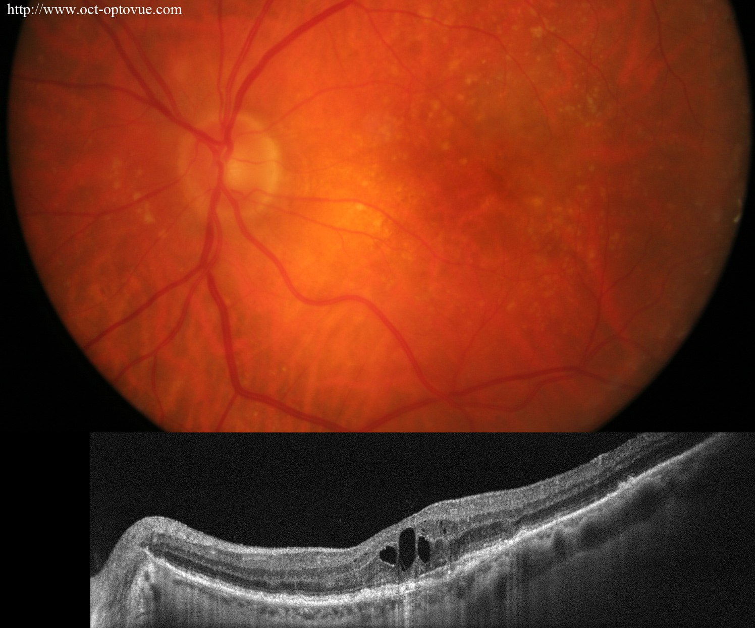 recurrent armd cnv recidvie