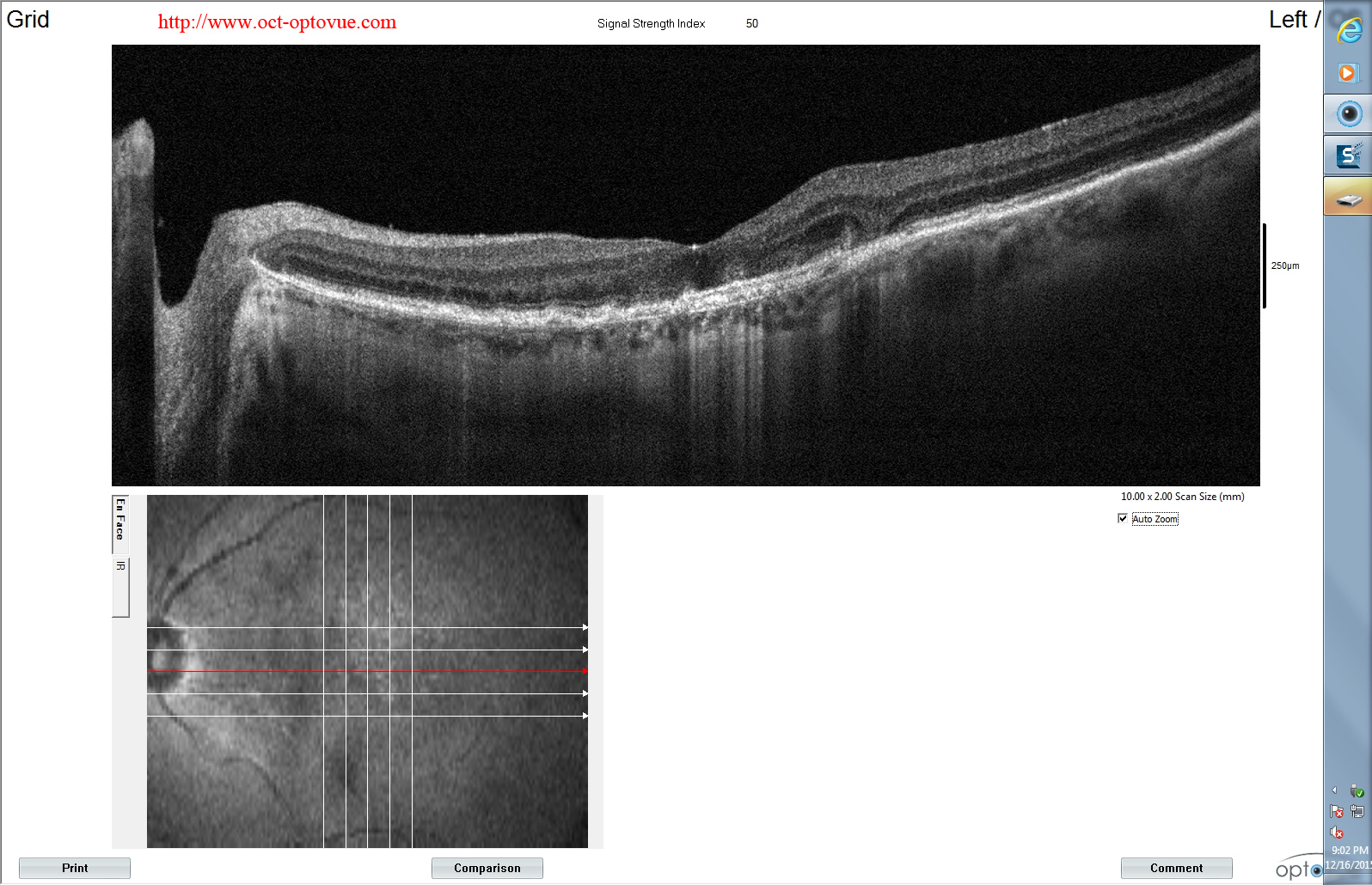 recurrent-cnv-retina oct no fluid