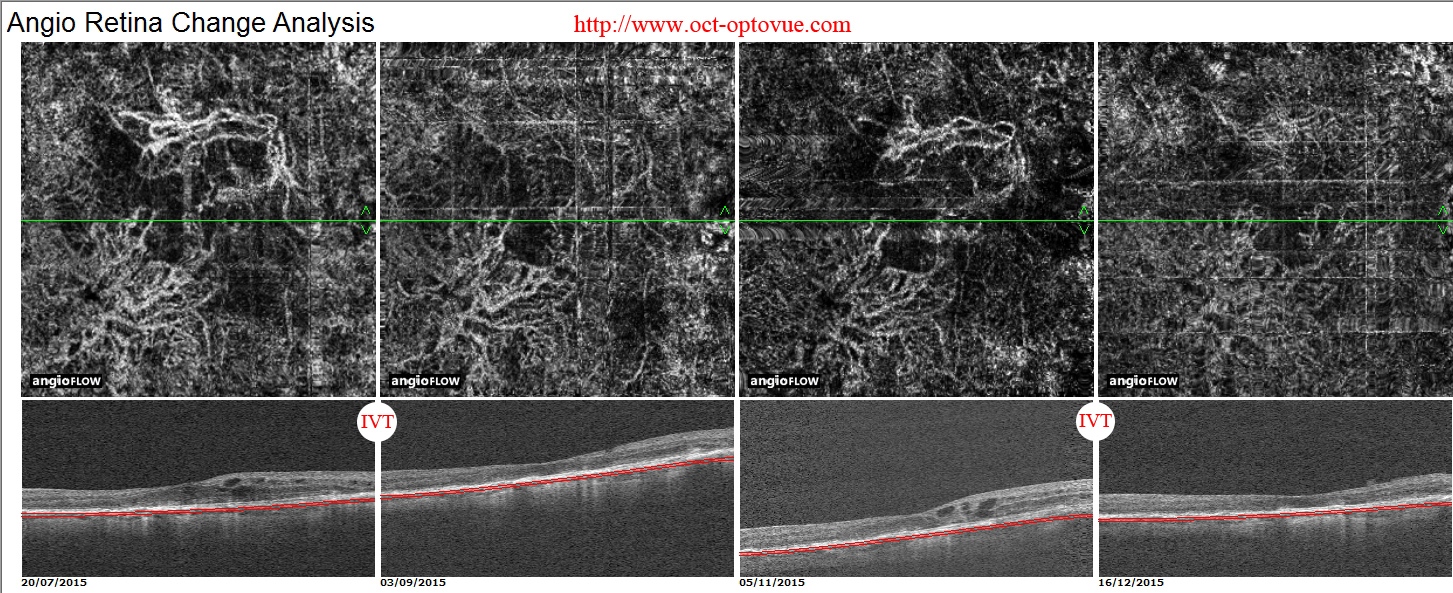 recurrent cnv retina