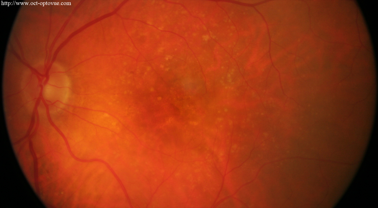 recurrent cnv retina optovue angiovue avanti