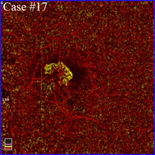 AMD-color-overlay optovue angio-oct