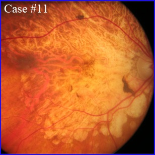 angio-atrophy-retina-304