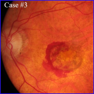 armd hemorrhage hémorragie maculaire angiovue