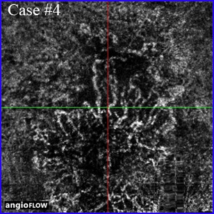 armd amd lucentis eylea dmla oct angiography