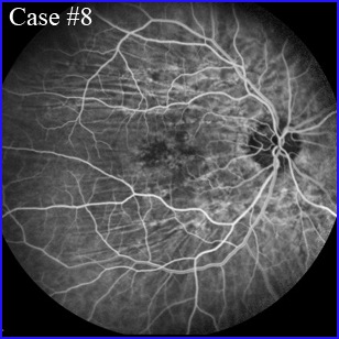 cnv-oct-angiography 304