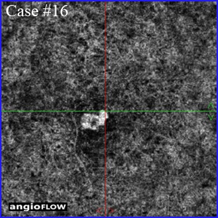 optovue amd and cnv octa