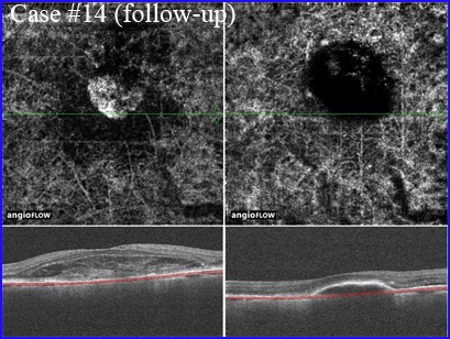 pre-post-anti-vegf lucentis eylea