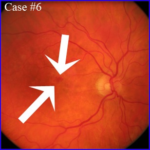 recurrent cnv neovascularization armd