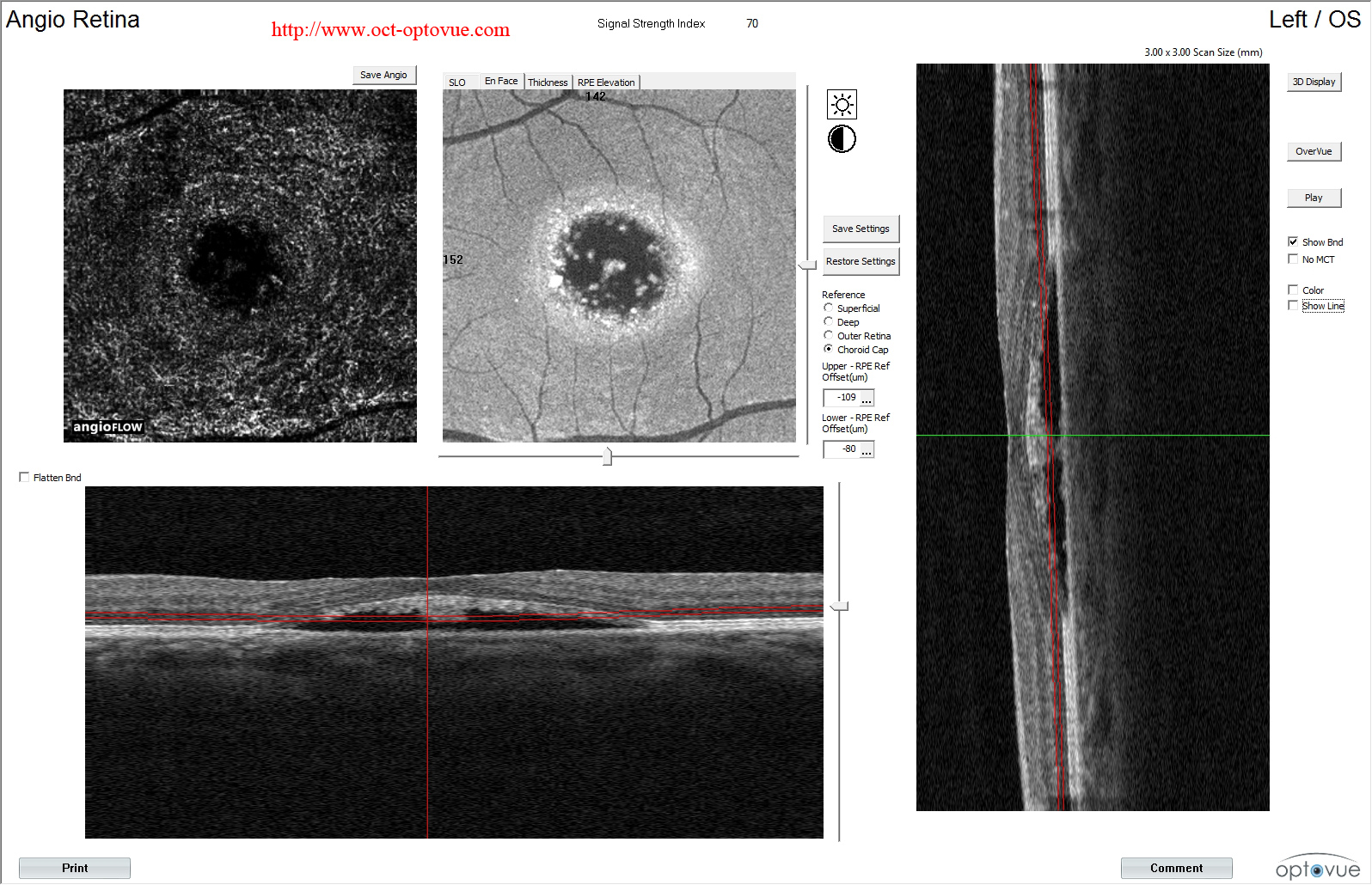 oct angio crsc csr serous sereuse centrale retina