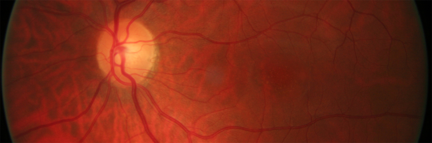 oct-angio crsc csr retina