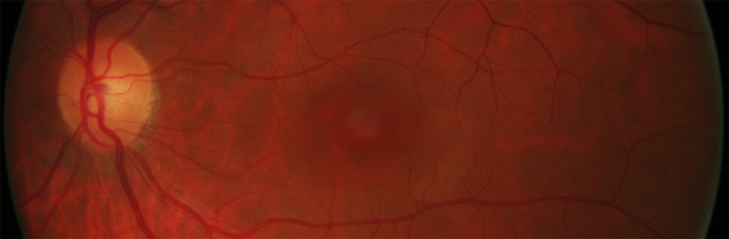 oct-angio crsc csr retina