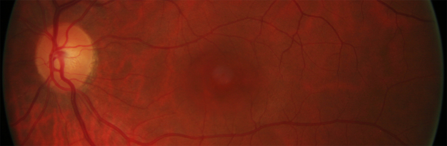 oct-angio crsc csr retina