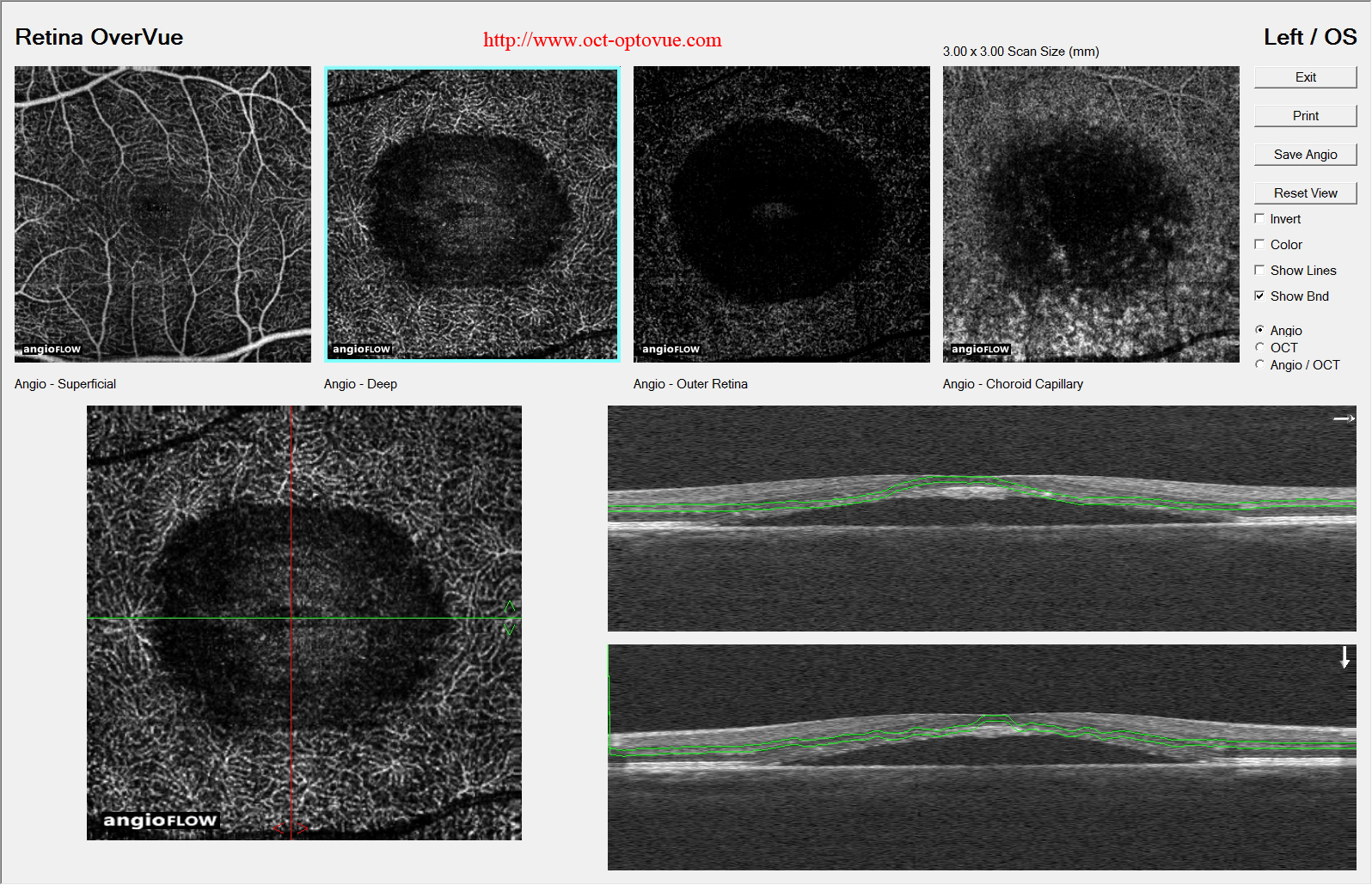 oct-angio crsc csr retina recurrence