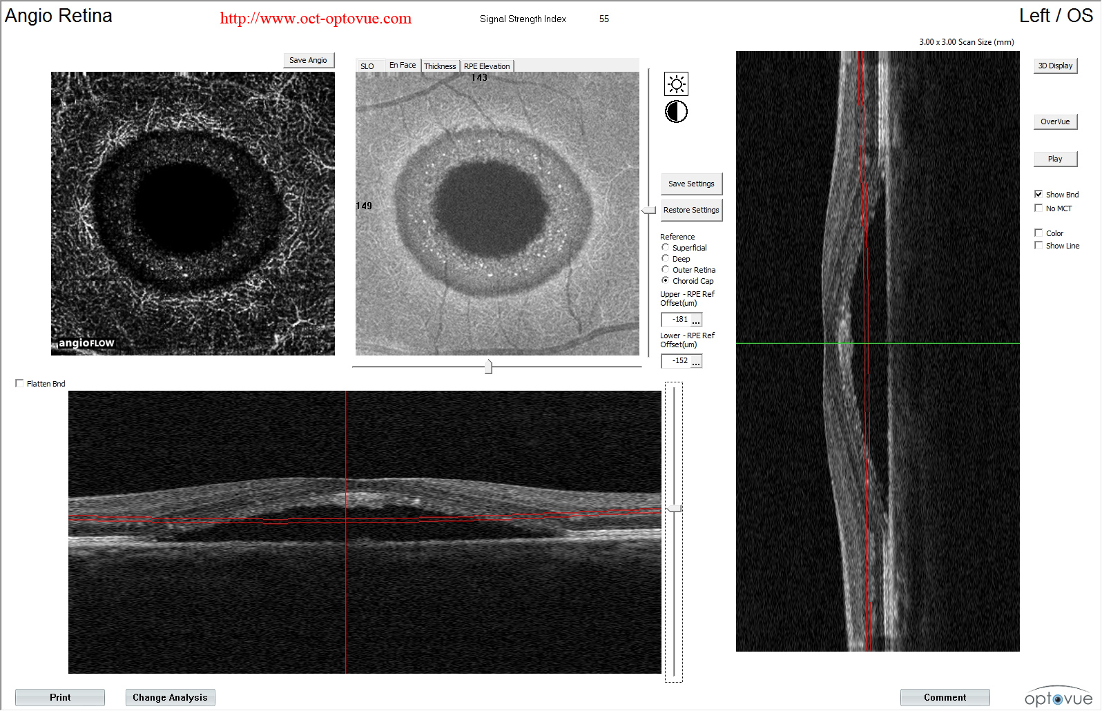 oct-angiography crsc csr retina