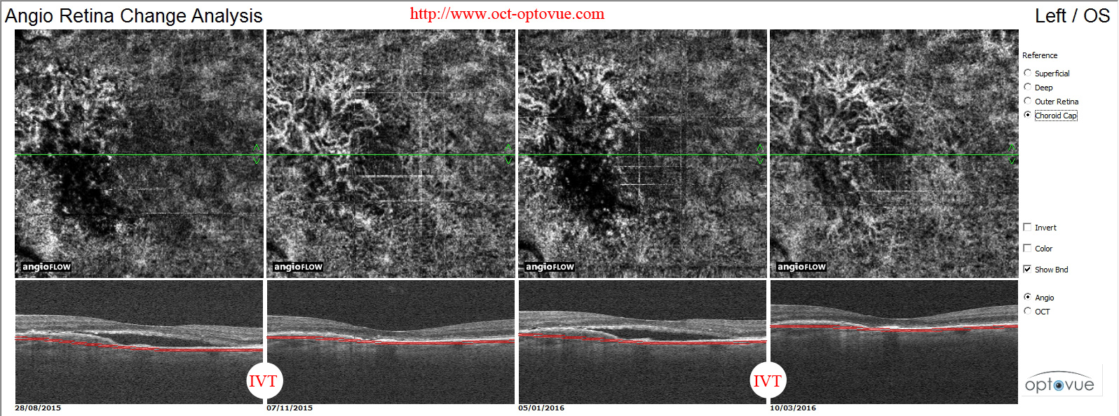 csc-csr-cnv central serous chorioretinopathy oct angiography