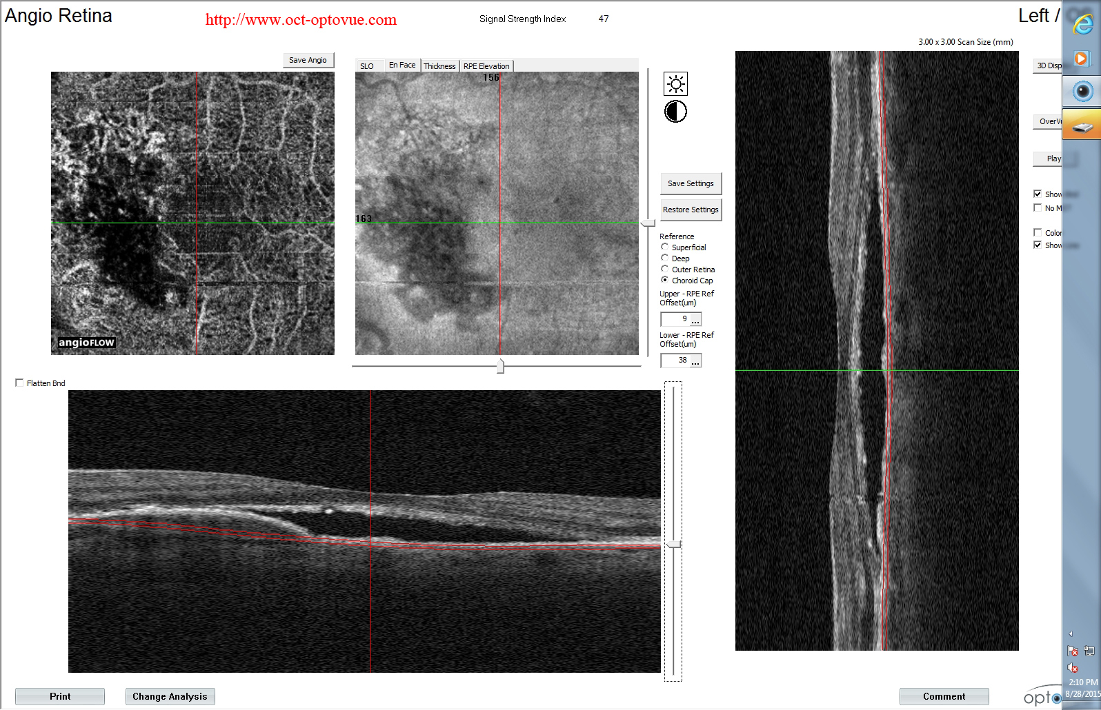 csr cnv oct angiography