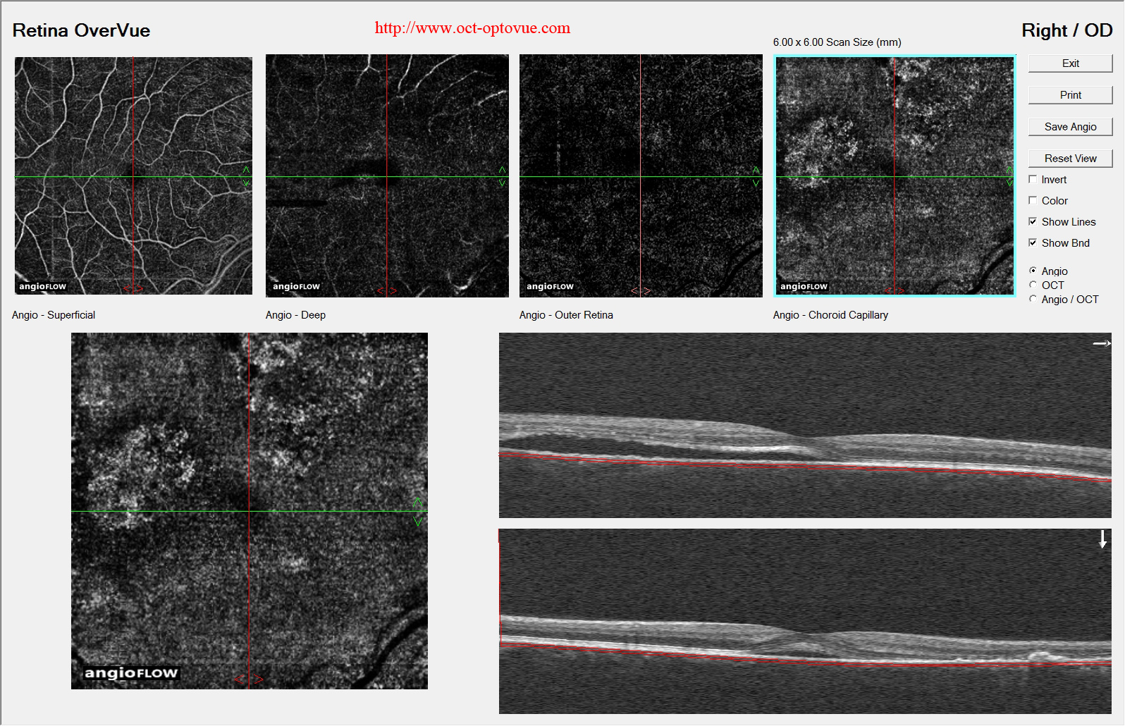 ccsc Chronic central serous chorioretinopathy CCSC oct-angiography