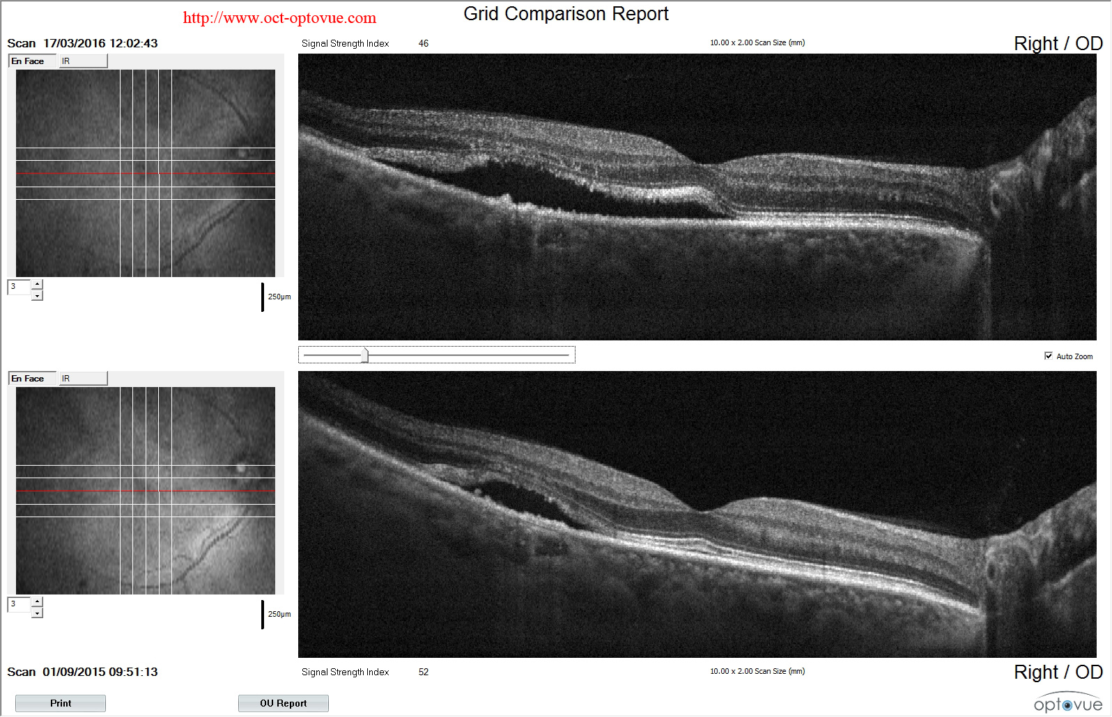 ccsc Chronic central serous chorioretinopathy oct