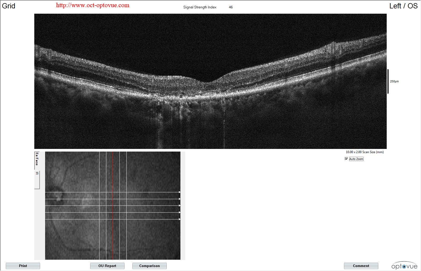 ccsc Chronic central serous chorioretinopathy oct os