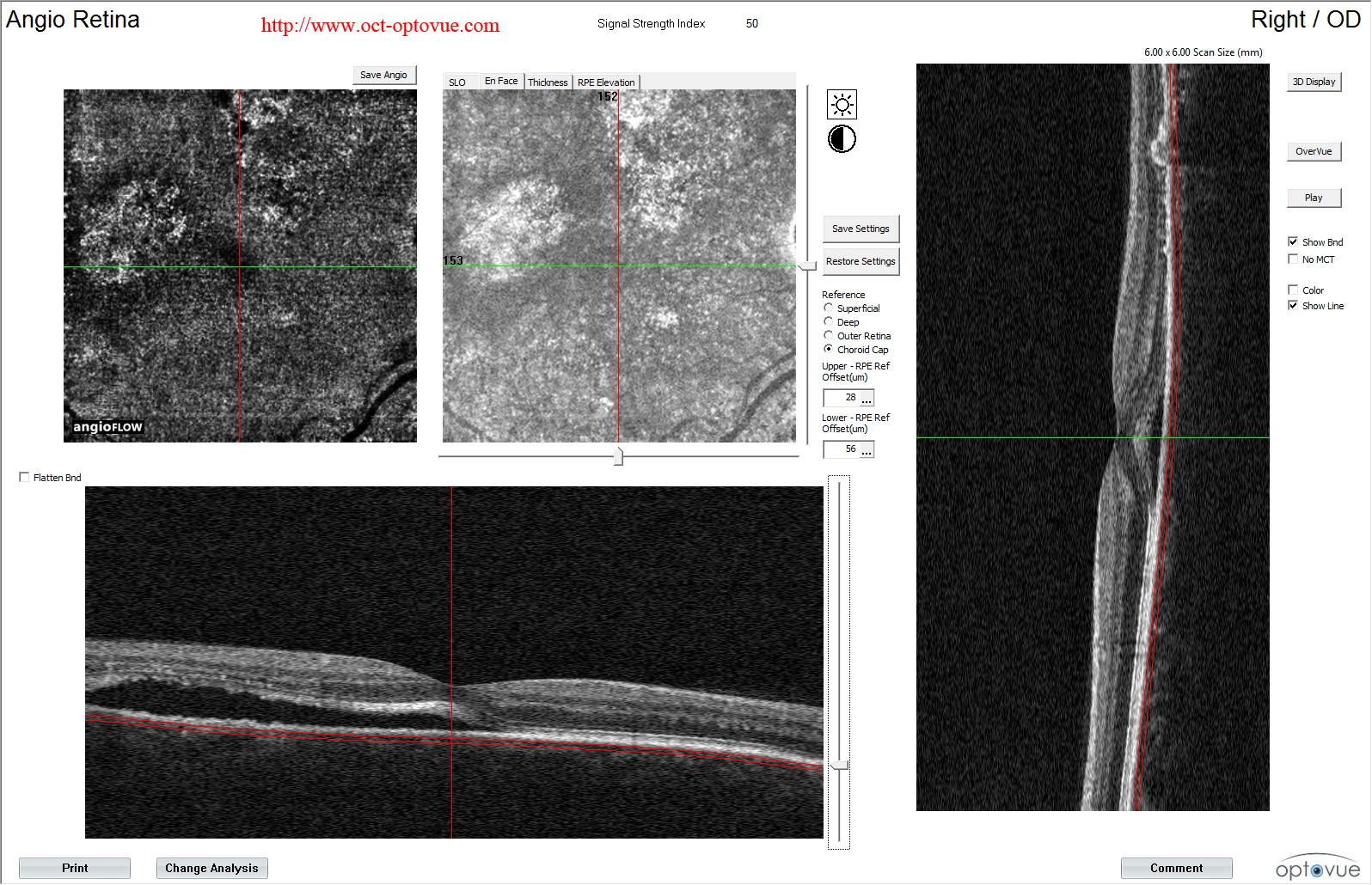 Chronic-central-serous-chorioretinopathy-oct-angiography