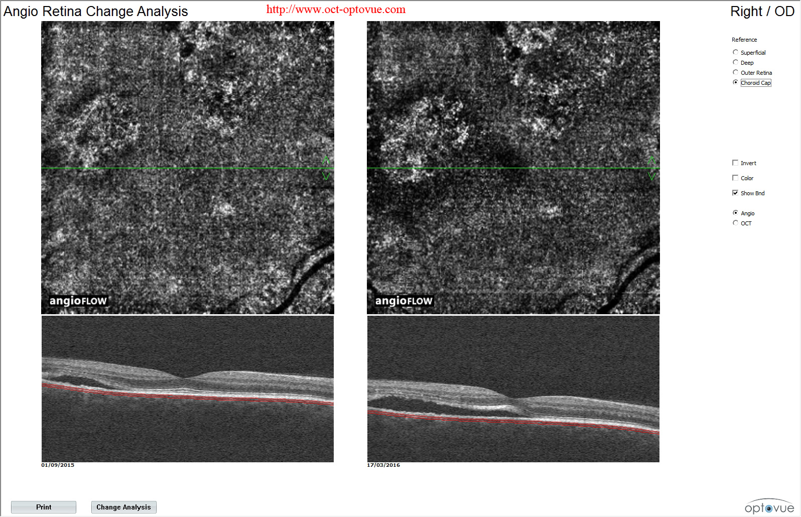 chronic csc oct-angiography