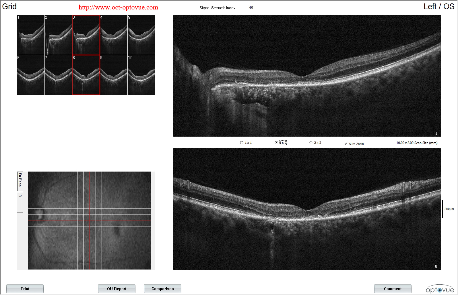 ccsc Chronic central serous chorioretinopathy oct