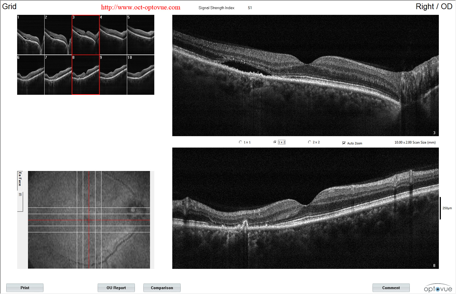 ccsc Chronic central serous chorioretinopathy oct