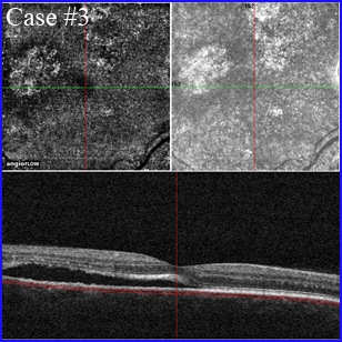 chronic-csr Chronic central serous chorioretinopathy (CCSC)