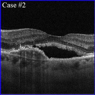 csr-cnv oct angiography