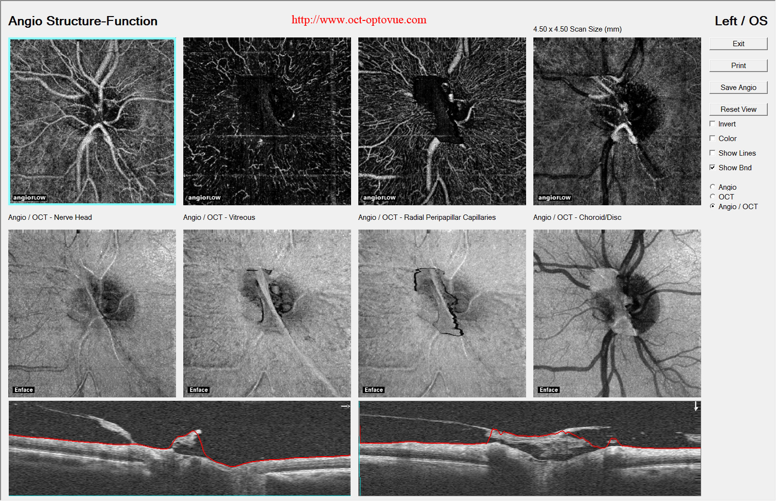 angio-optic-nerve diabete retinopathy proliferativ