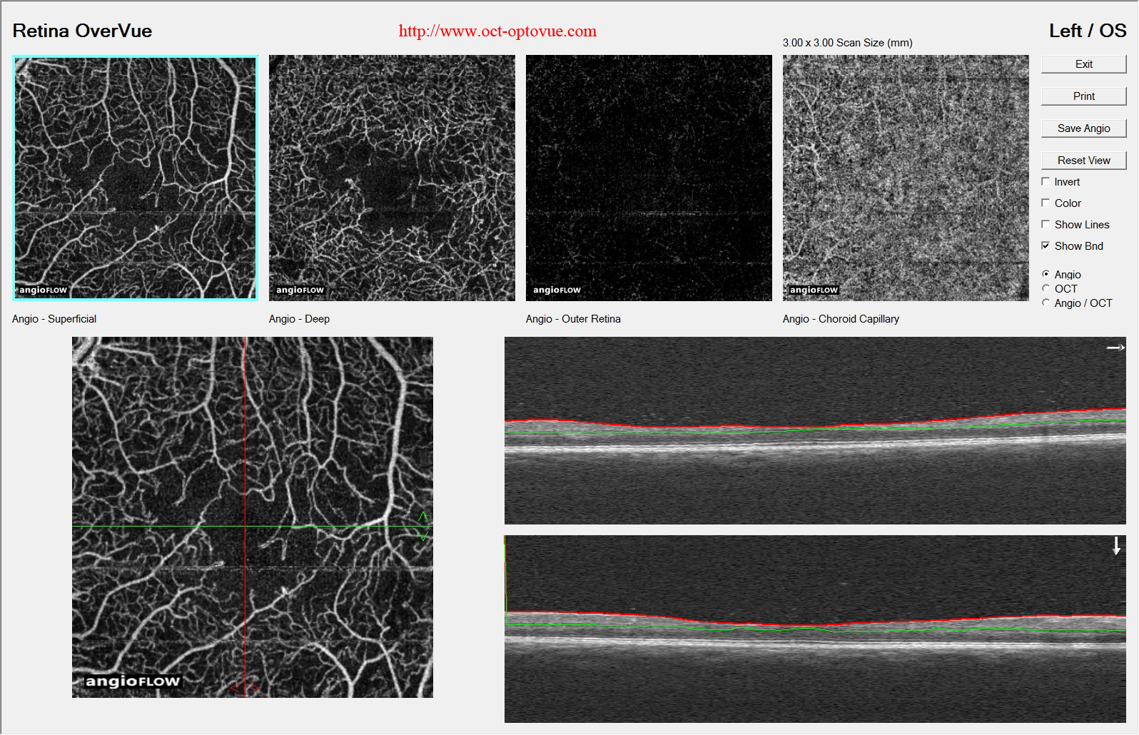 octa diabetes-capillaries oct angiography