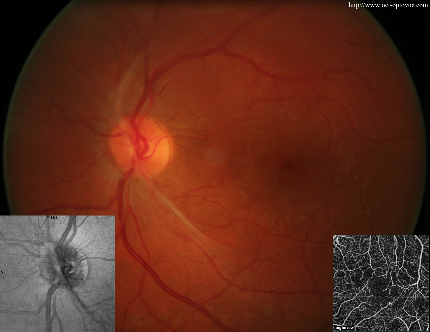 octa diabetes proliferative retinopathy