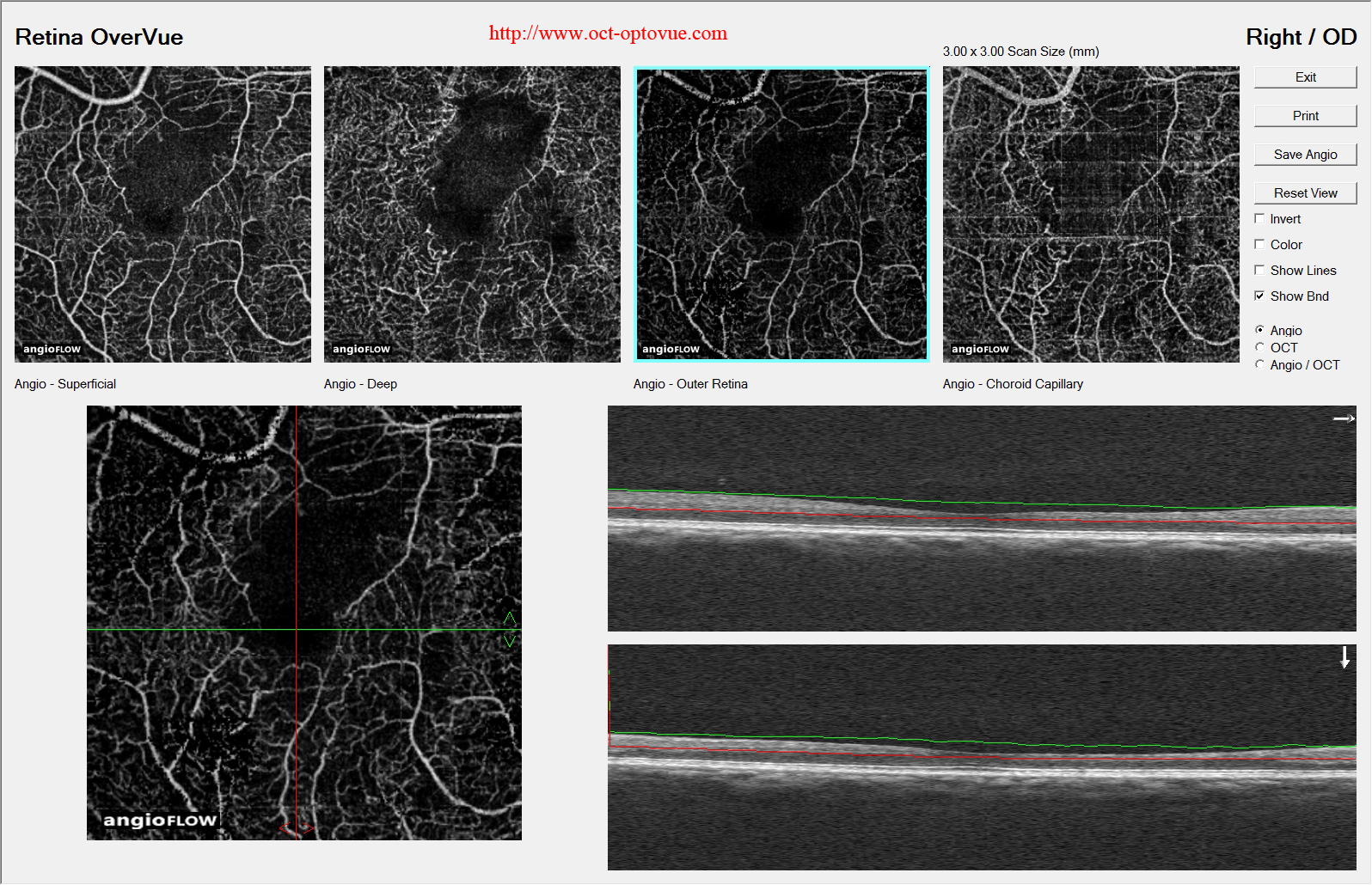 angio oct diabetes retina overvue