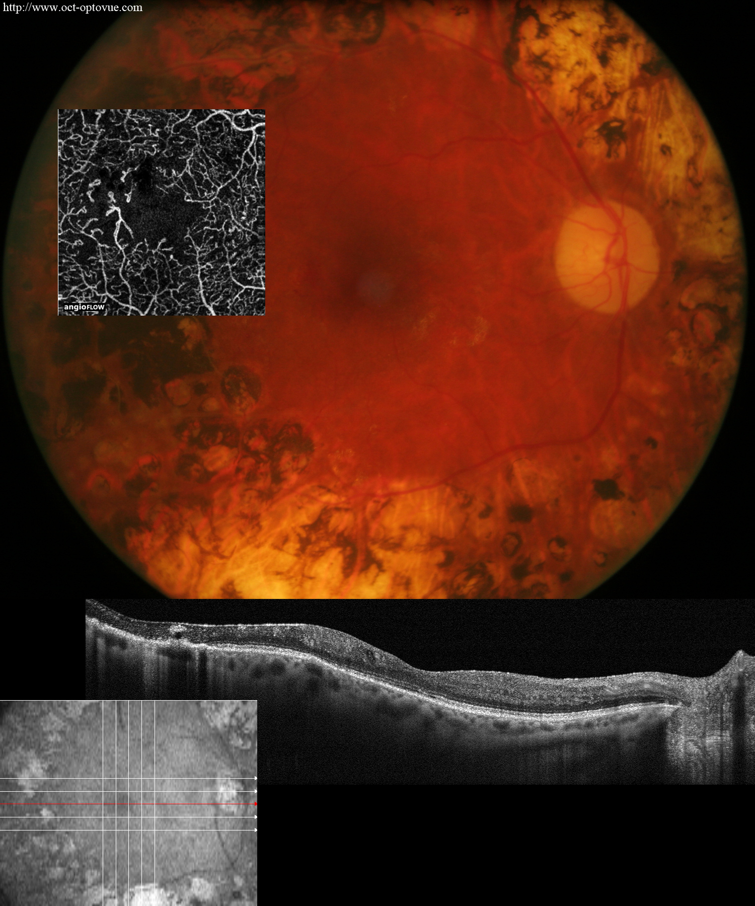 angio oct diabetes angiovue oct angiography