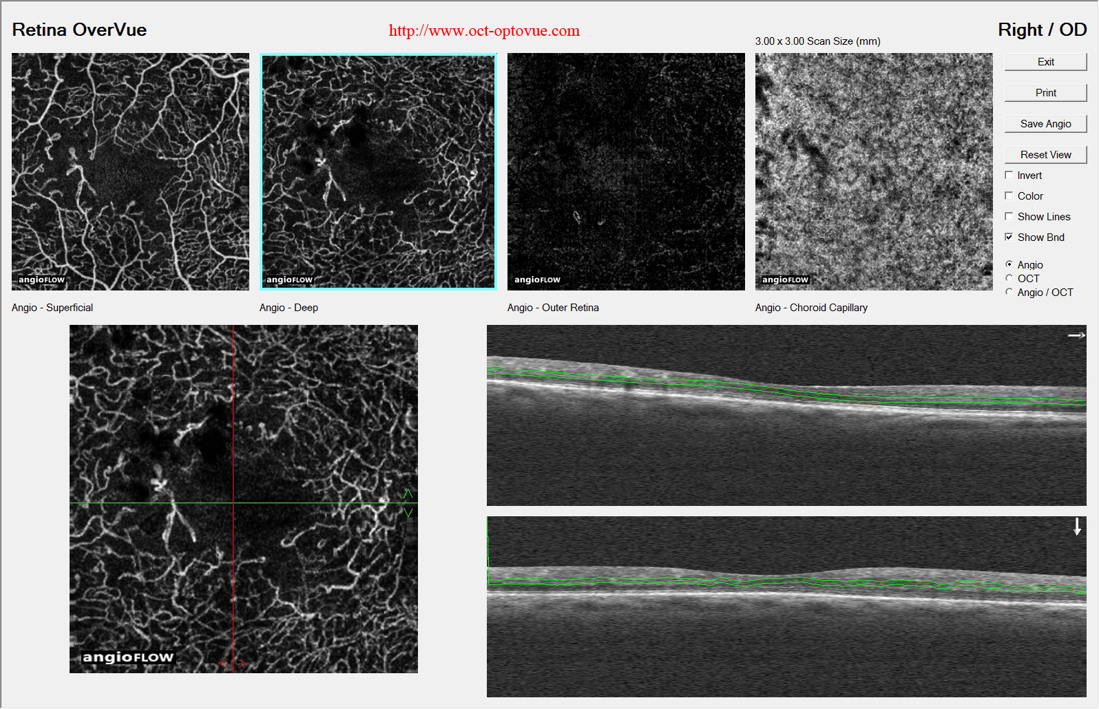 angio diabetes angiovue oct angiography