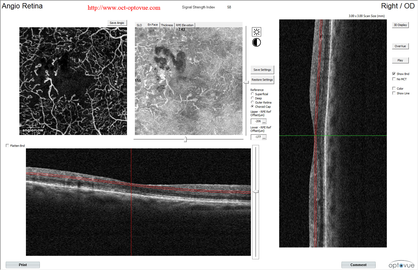 angio diabetes angiovue oct angiography