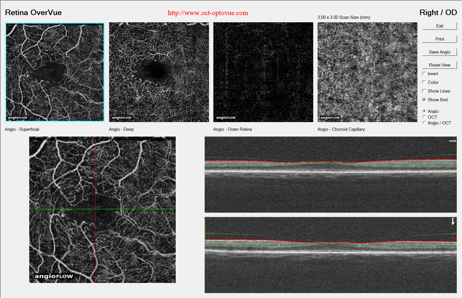 oct-diabetes angiography maculopathy
