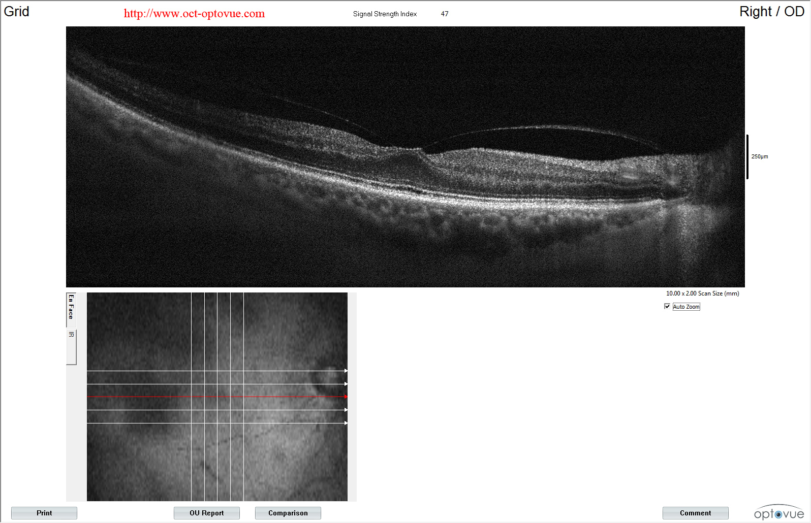 oct-diabetes retina