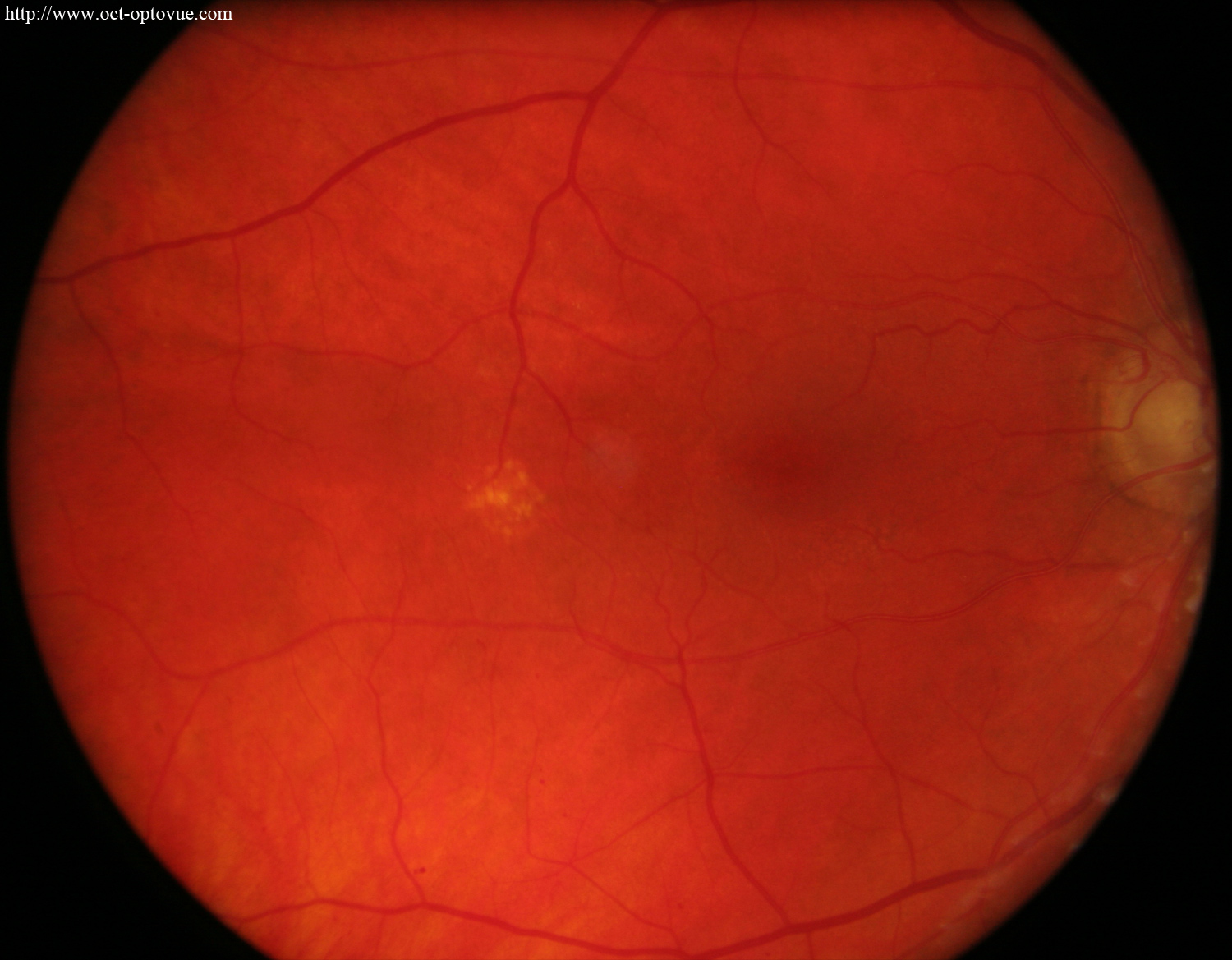 oct diabetes traction diabete capillaire